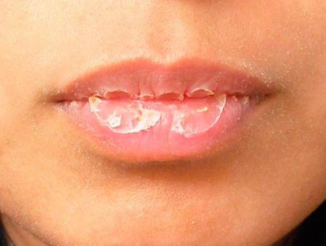 Почему сохнут и трескаются губы и что с этим делать | Evolutis Clinic | Дзен